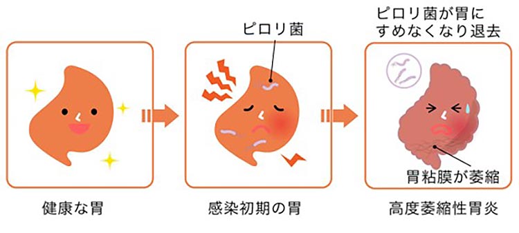 慢性胃炎イメージ