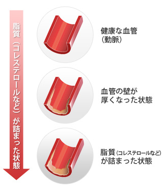 動脈硬化イメージ