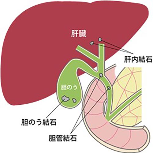胆のう結石イメージ